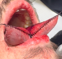 Tongue Splitting