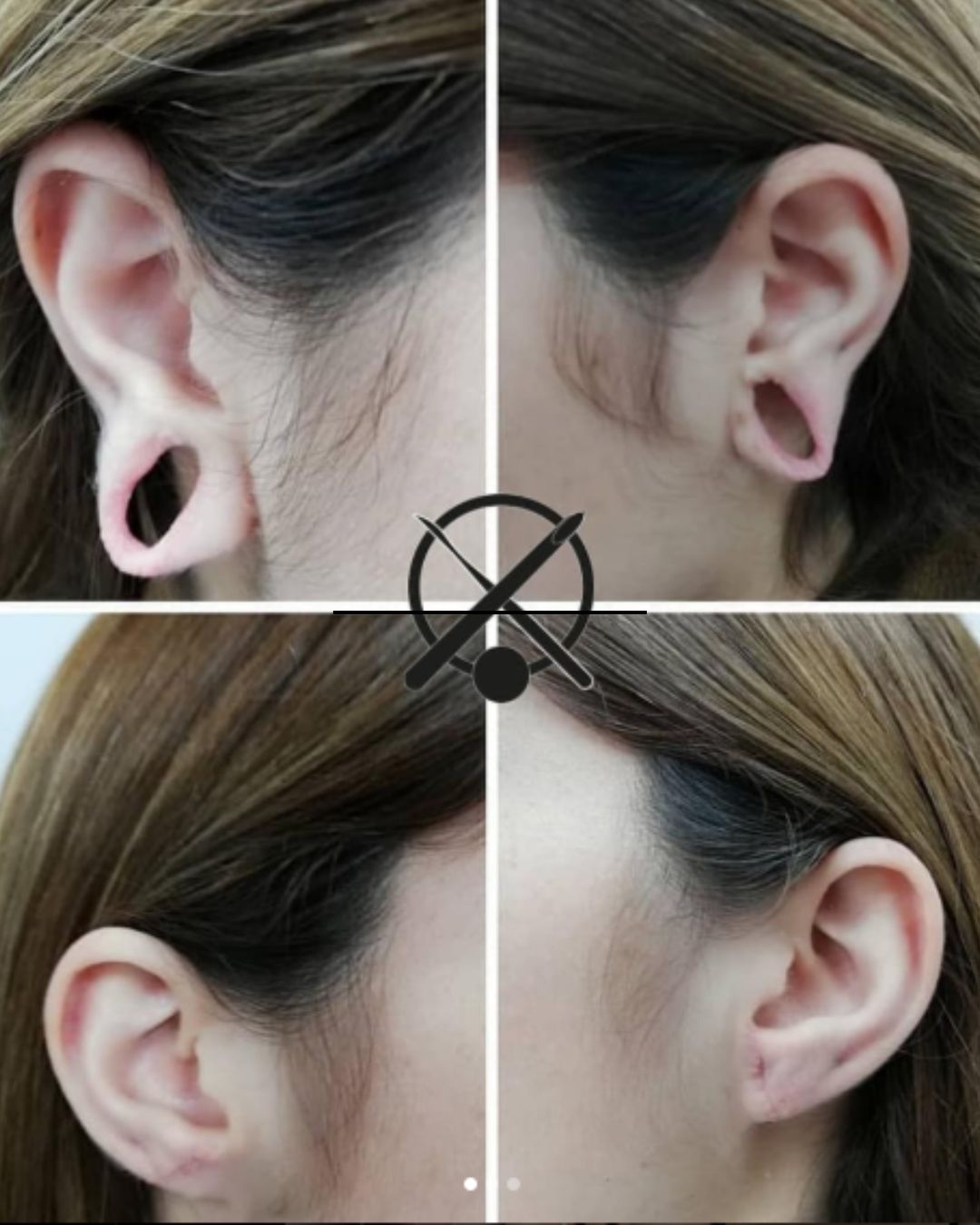 Earlobe Reconstruction